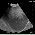 A Case Report of Glycogenic Hepatopathy 1 Creative Commons images