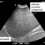 A Case Report of Glycogenic Hepatopathy 4 Creative Commons images