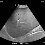 A Case Report of Glycogenic Hepatopathy 3 Creative Commons images