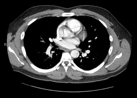 Case Report: Thoracic Aortic Dissection in a Previously Healthy Male with an Unusual Inciting Factor 2 Creative Commons images