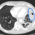 Case Report of an Empyema Identified on Lung Ultrasound 2 Creative Commons images