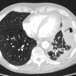 Case Report of an Empyema Identified on Lung Ultrasound 1 Creative Commons images