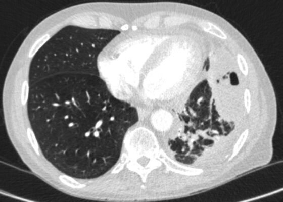 Case Report of an Empyema Identified on Lung Ultrasound 4 Creative Commons images