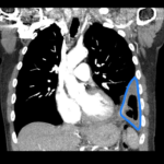 Case Report of an Empyema Identified on Lung Ultrasound 4 Creative Commons images