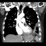Case Report of an Empyema Identified on Lung Ultrasound 3 Creative Commons images