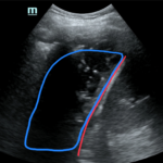 Case Report of an Empyema Identified on Lung Ultrasound 6 Creative Commons images