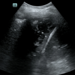Case Report of an Empyema Identified on Lung Ultrasound 5 Creative Commons images