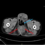 A Case Report of Fournier’s Gangrene 2 Creative Commons images