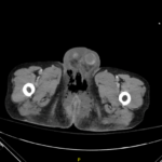 A Case Report of Fournier’s Gangrene 1 Creative Commons images
