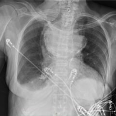 A Case Report of a Large Goiter Resulting in Tracheal Deviation 7 Creative Commons images