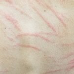 A Culinary Misadventure: A Case Report of Shiitake Dermatitis 1 Creative Commons images