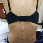 A Culinary Misadventure: A Case Report of Shiitake Dermatitis 2 Creative Commons images