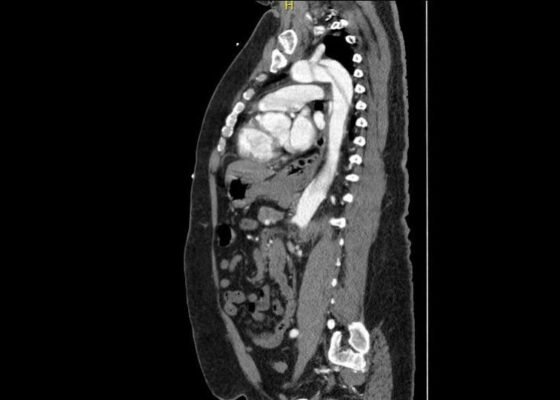 A Case Report of Aortic Dissection Involving the Aortic Root, Left Common Carotid Artery, and Iliac Arteries 8 Creative Commons images