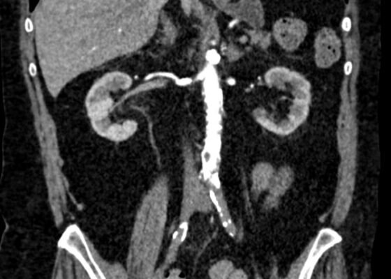 Initial Management and Recognition of Aortoiliac Occlusive Disease, A Case Report 2 Creative Commons images