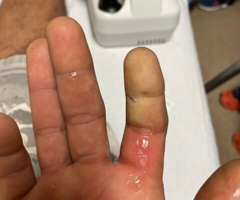 A Case Report of the Rapid Evaluation of a High-Pressure Injection Injury of a Finger Leading to Positive Outcomes 2 Creative Commons images