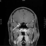 Case Report of a Man with Right Eye Pain and Double Vision 5 Creative Commons images