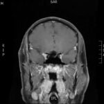 Case Report of a Man with Right Eye Pain and Double Vision 4 Creative Commons images