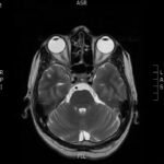 Case Report of a Man with Right Eye Pain and Double Vision 2 Creative Commons images