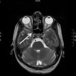 Case Report of a Man with Right Eye Pain and Double Vision 3 Creative Commons images