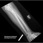 High-Pressure Injection Injury to the Hand - A Case Report 2 Creative Commons images
