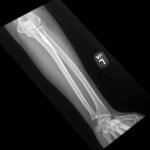 High-Pressure Injection Injury to the Hand - A Case Report 1 Creative Commons images