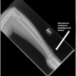 High-Pressure Injection Injury to the Hand - A Case Report 4 Creative Commons images