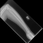 High-Pressure Injection Injury to the Hand - A Case Report 3 Creative Commons images