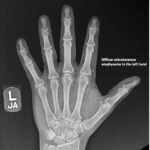 High-Pressure Injection Injury to the Hand - A Case Report 6 Creative Commons images