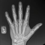 High-Pressure Injection Injury to the Hand - A Case Report 5 Creative Commons images