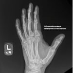 High-Pressure Injection Injury to the Hand - A Case Report 8 Creative Commons images