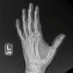 High-Pressure Injection Injury to the Hand - A Case Report 7 Creative Commons images