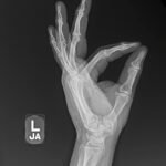 High-Pressure Injection Injury to the Hand - A Case Report 9 Creative Commons images