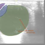 Vitreous Hemorrhage Case Report 2 Creative Commons images