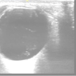 Vitreous Hemorrhage Case Report 1 Creative Commons images