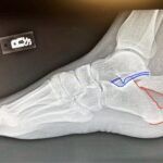 Case Report of a Tongue-Type Calcaneal Fracture 2 Creative Commons images