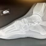 Case Report of a Tongue-Type Calcaneal Fracture 1 Creative Commons images