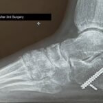 Case Report of a Tongue-Type Calcaneal Fracture 20 Creative Commons images