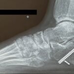 Case Report of a Tongue-Type Calcaneal Fracture 19 Creative Commons images