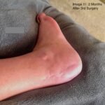 Case Report of a Tongue-Type Calcaneal Fracture 22 Creative Commons images