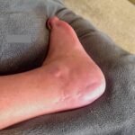 Case Report of a Tongue-Type Calcaneal Fracture 21 Creative Commons images