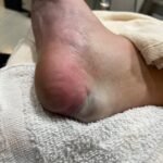 Case Report of a Tongue-Type Calcaneal Fracture 3 Creative Commons images