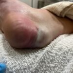 Case Report of a Tongue-Type Calcaneal Fracture 5 Creative Commons images