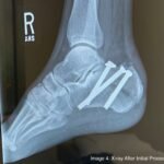 Case Report of a Tongue-Type Calcaneal Fracture 8 Creative Commons images