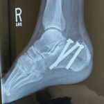 Case Report of a Tongue-Type Calcaneal Fracture 7 Creative Commons images