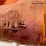 Case Report of a Tongue-Type Calcaneal Fracture 10 Creative Commons images