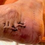 Case Report of a Tongue-Type Calcaneal Fracture 9 Creative Commons images