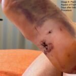 Case Report of a Tongue-Type Calcaneal Fracture 12 Creative Commons images