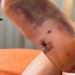 Case Report of a Tongue-Type Calcaneal Fracture 11 Creative Commons images