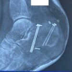 Case Report of a Tongue-Type Calcaneal Fracture 13 Creative Commons images