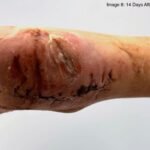 Case Report of a Tongue-Type Calcaneal Fracture 16 Creative Commons images